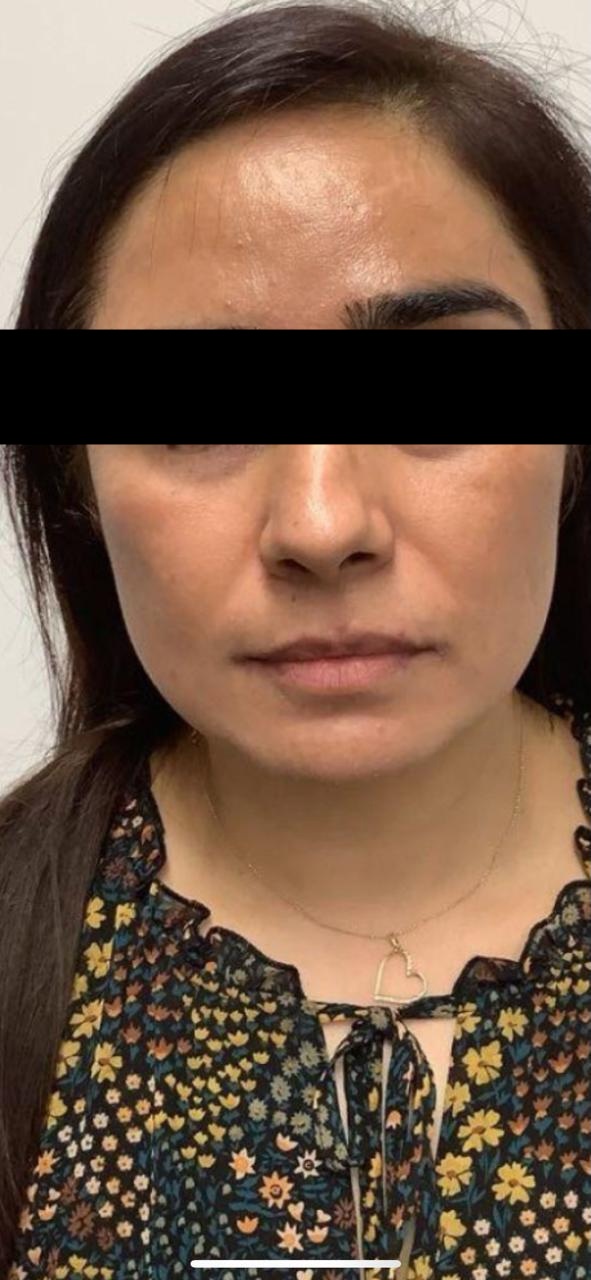 Brightening treatment after