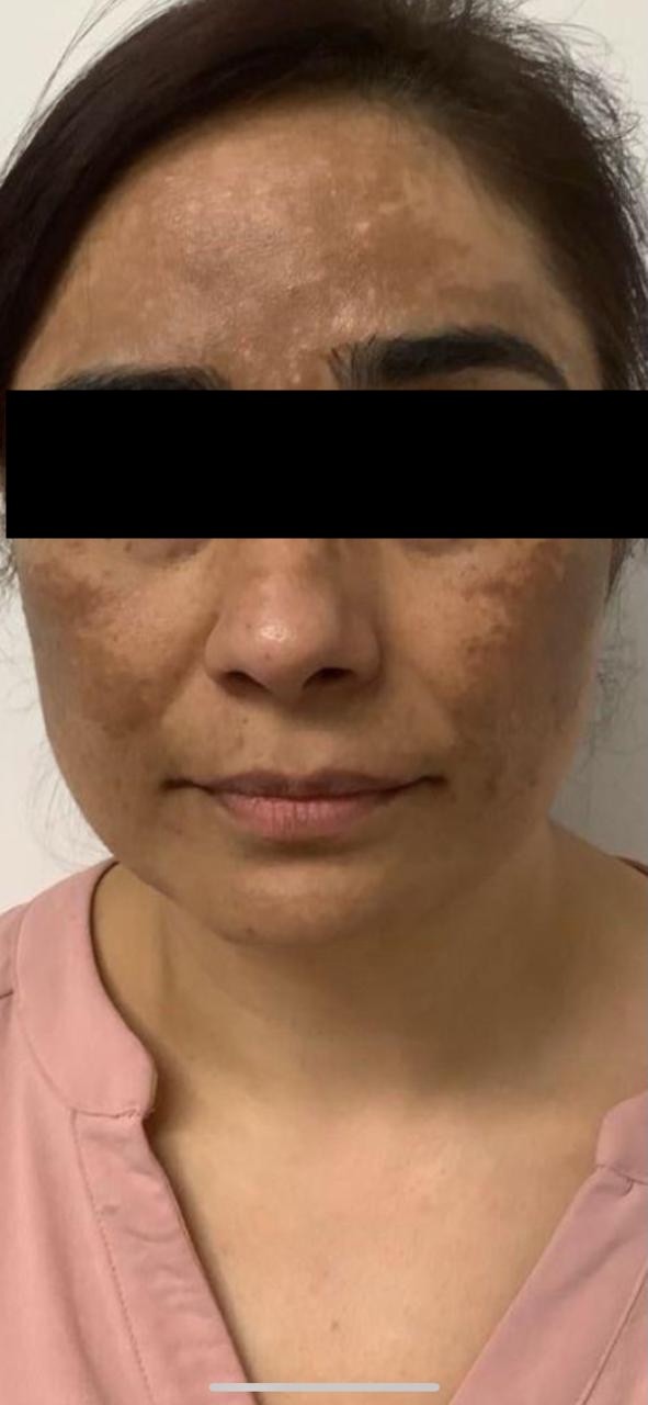 Brightening treatment before