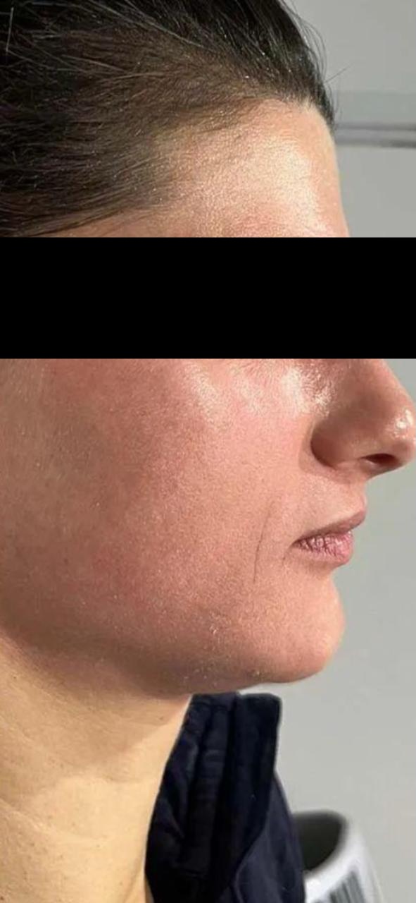 Pigmentation treatment after