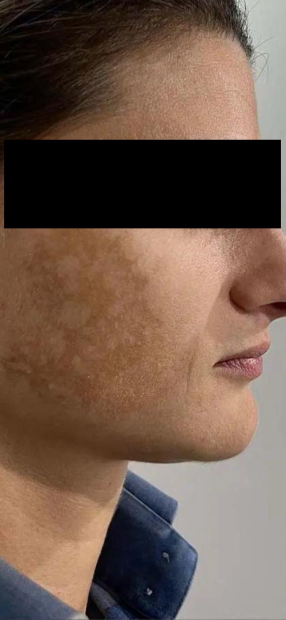 Pigmentation treatment before